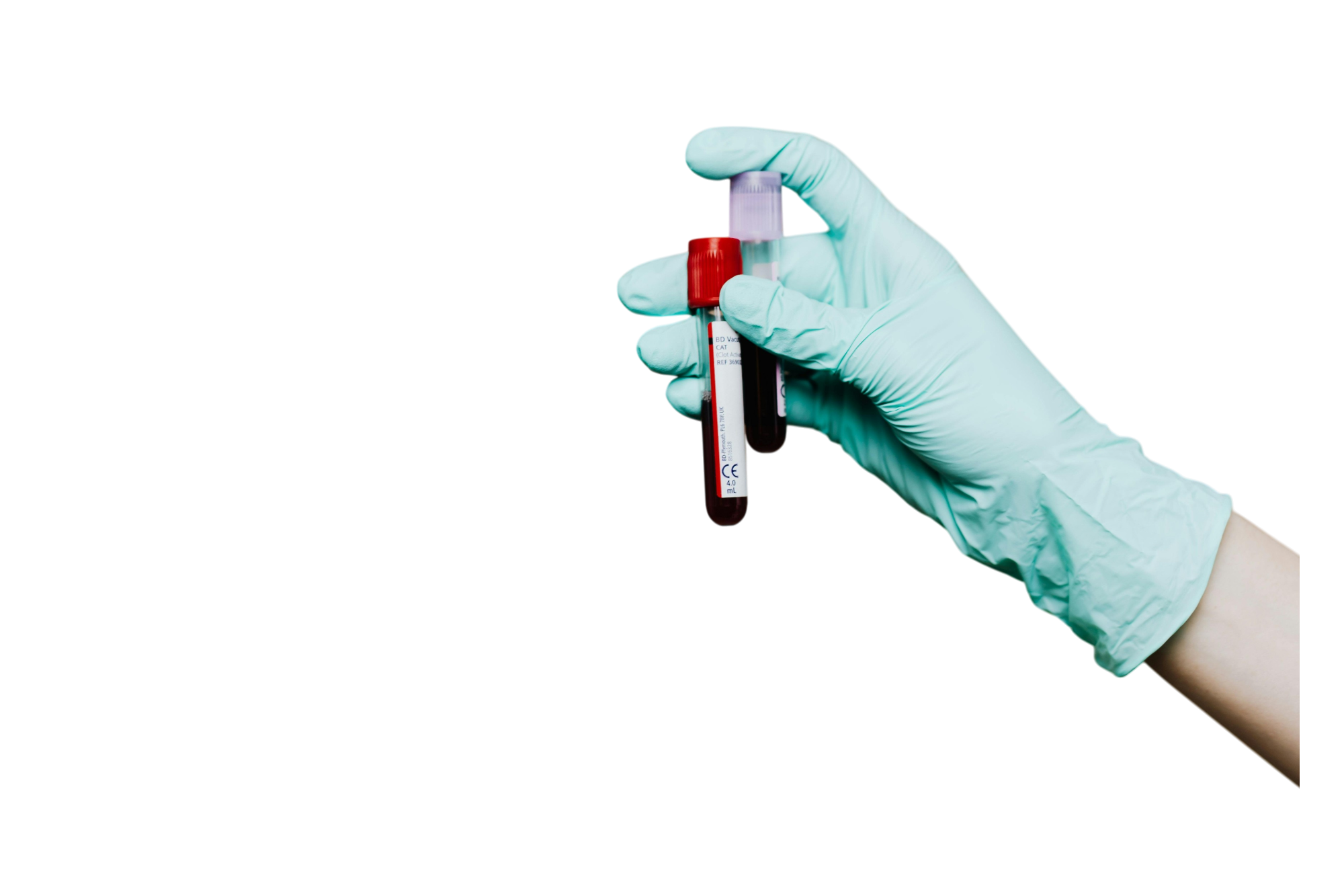 Анализ крови на билирубин общий в Москве